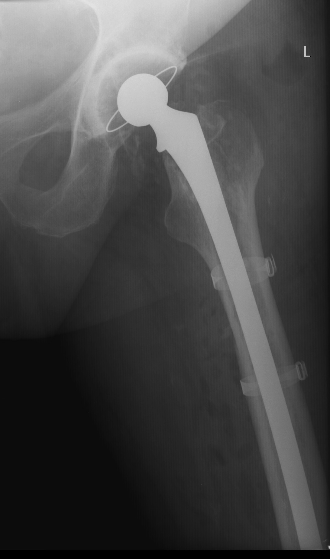 THR Periprosthetic Revision Long Cemented Femur